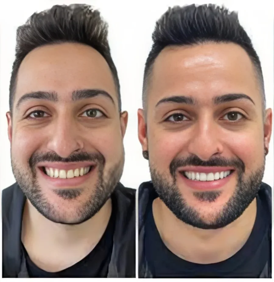 Real Invisalign before and after result from a Delta Dental Care patient
